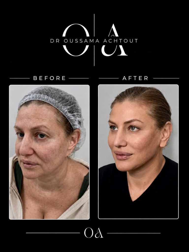 Avant après lifting visage profil