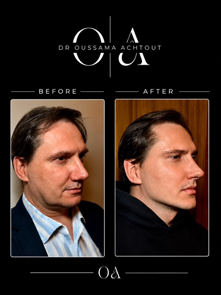 Avant après rajeunissement facial complet