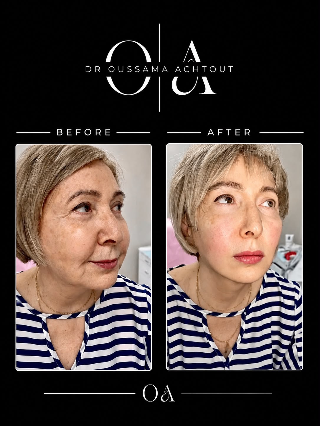 Avant après revitalisation faciale