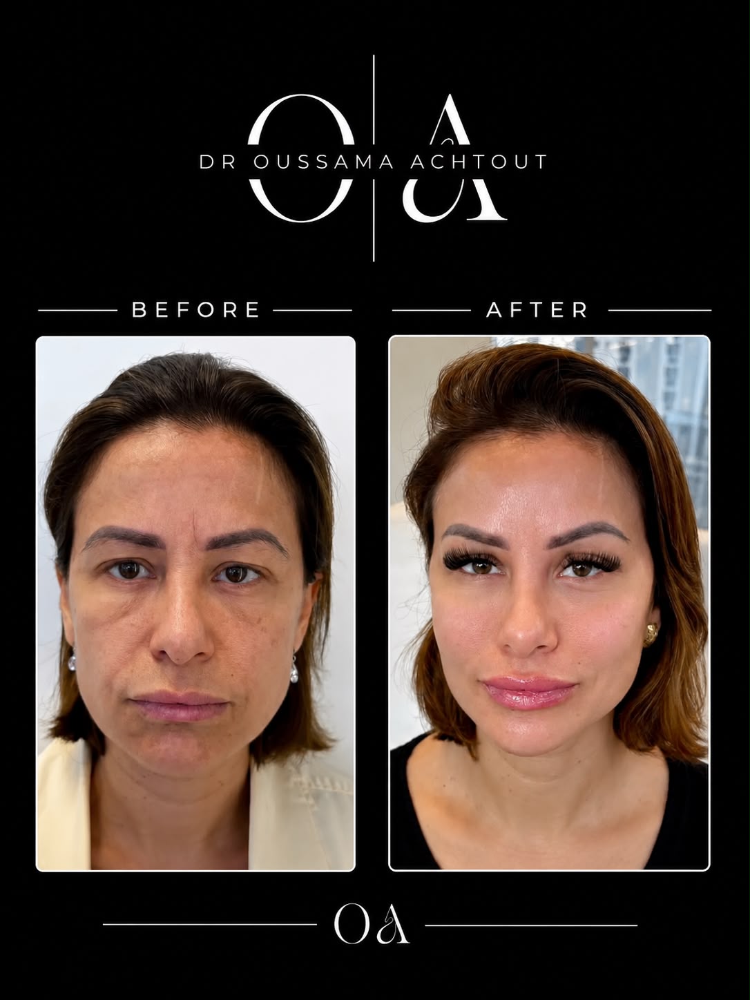 Avant après jawline contouring