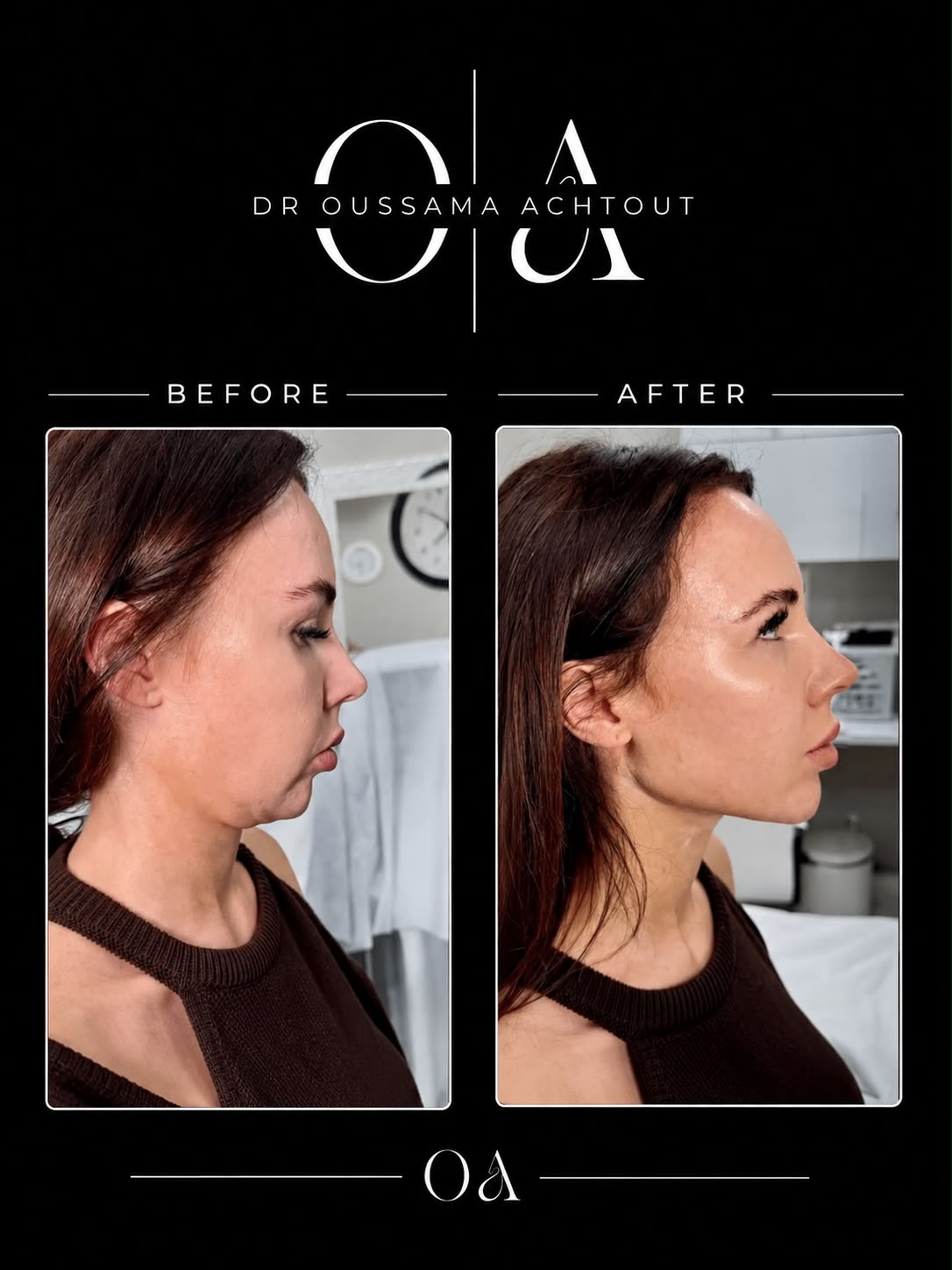 Avant après botox zones expressives